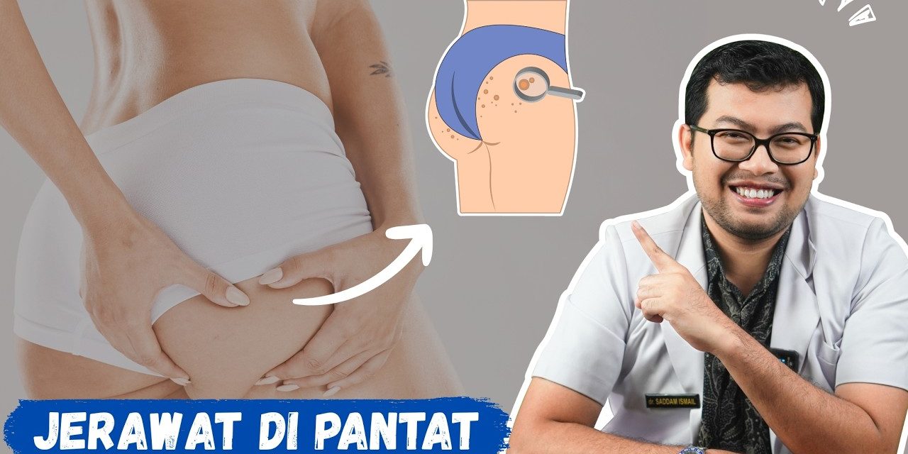 Jerawat Di Bokong, Inilah Penyebab Dan Cara Pengobatannya